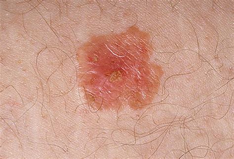 Pictures Of Skin Cancer Early Stages Of Skin Cancer