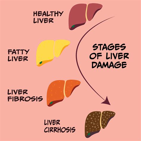 Progression Stages Of Liver Disease 5846231 Vector Art At Vecteezy