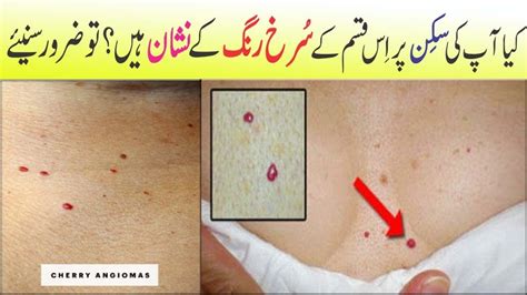 Do You Have These Red Spots On Your Skin Anam Home Remedy Youtube