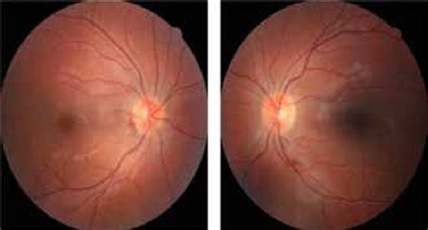 Papilledema Was Observed To Have Receded In Both Eyes At The 2 Month