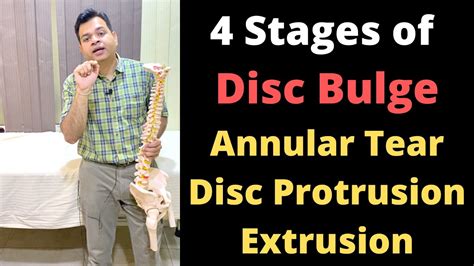 Stages Of Disc Bulge Annular Tear Disc Protrusion Disc Extrusion