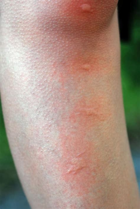 Mosquito Bite Allergy Symptoms Mosquito Bite Reaction Meaning Ph
