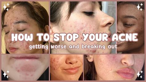How To Stop Your Acne Getting Worse And Breaking Out 🤍 Acne