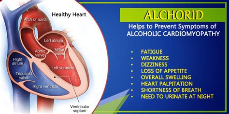 Alcoholic Cardiomyopathy Long Term Effect Symptoms Treat