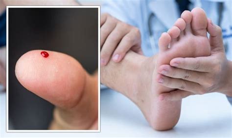 Diabetes Symptoms Brown Spots On The Sides Of The Feet Could Be A Sign