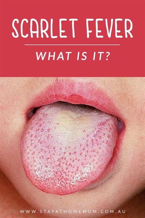 Scarlet Fever What Is It