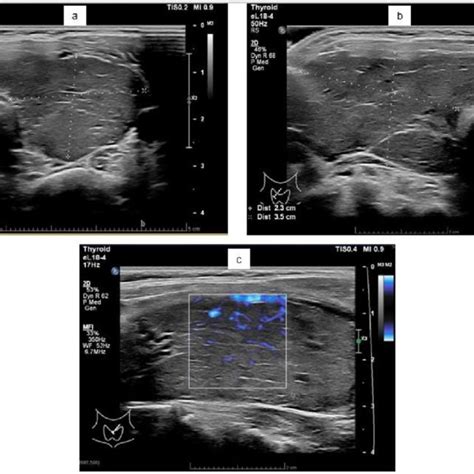 Thyroid Ultrasound In May 2020 Legend Text Transverse Views Of Both