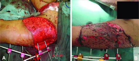 a a a a a-Degloving in left lower limb. Intraoperative evaluation after ...