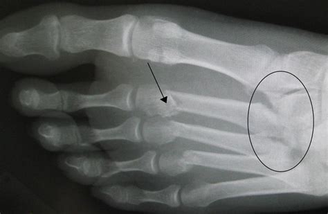 Lisfranc Fracture Dislocation A Review Of A Commonly Vrogue Co