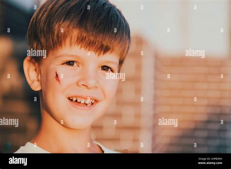 Portrait Of A Smiling Child With A Bruise On His Face Stock Photo Alamy