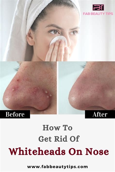 How To Get Rid Of Whiteheads On Nose Fab Beauty Tips