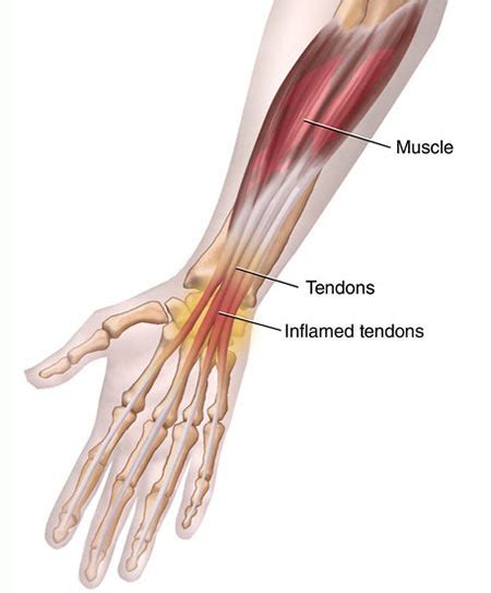 Wrist Tendonitis Treatment Doctor In Manhattan Nyc Sports Injury Clinic