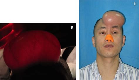 Patient With The Tissue Expander Inserted In Forehead A The Trend