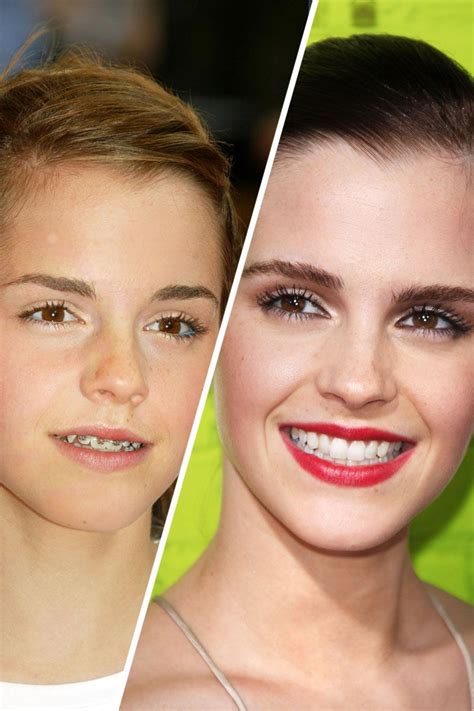 Famous Faces With Braces Celebrities With Braces Perfect Smile