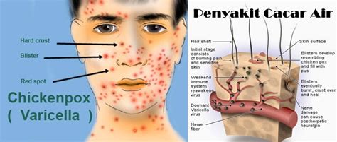 Describes things that can be done at home to help relieve chickenpox symptoms, as well as treatments that may be prescribed by a doctor. Cara Hilangkan Parut Chicken Pox Dengan Berkesan | Idayu ...