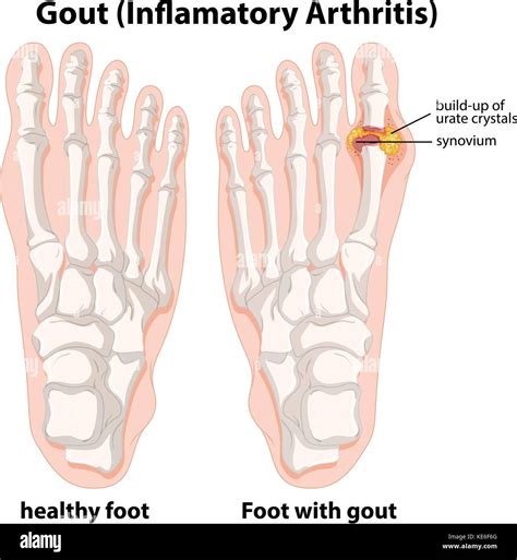 Diagram Explanation Of Gout In Human Foot Illustration Stock Vector