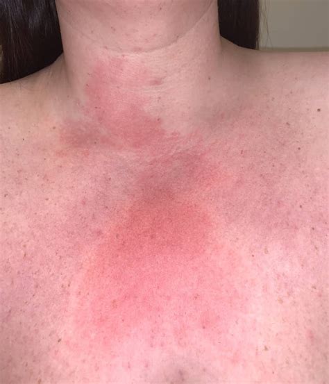 Itchy Rash On Upper Chest