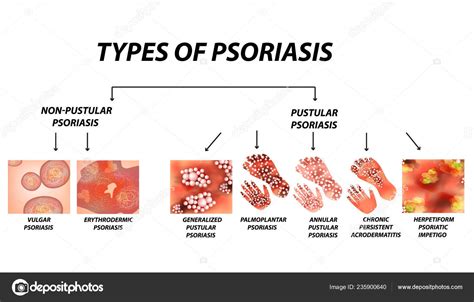 Types Psoriasis Pustular Pustular Vulgar Erythroderma Erythrodermic
