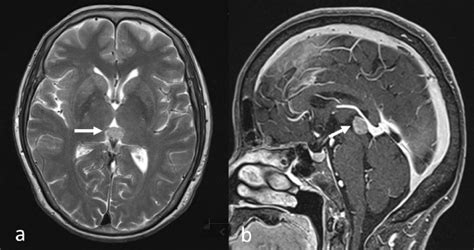 Pineal Gland Metastasis In A Patient With Lung Adenocarcinoma