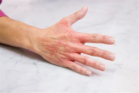 6 Home Remedies For Winter Rashes Heal Winter Rashes With Some Natural