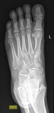 Avulsion Fracture Of The 5th Metatarsal Styloid Radiology Case