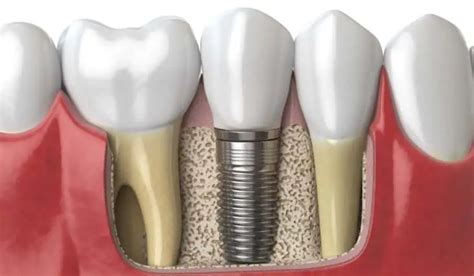 Qué es injerto de hueso dental tipos y para qué sirve