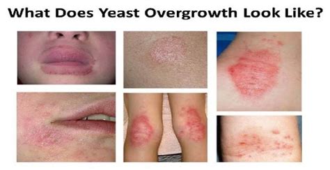 Symptoms Of Yeast Overgrowth In Intestines Unaresurvival