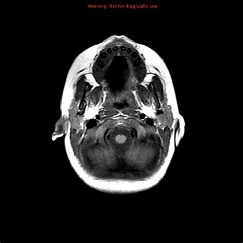 Joubert Syndrome Radiology Case