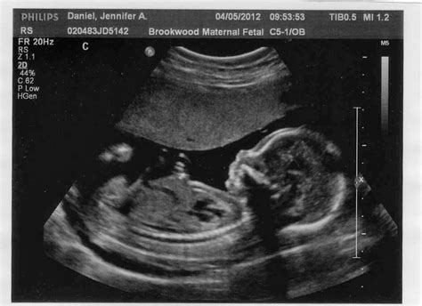 In The Daniels Den 20 Weeks Ultrasound