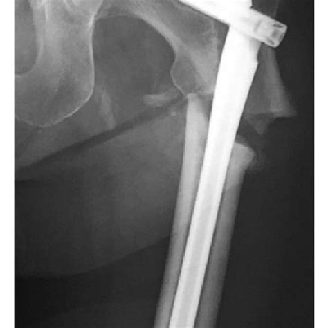 A An Ap Radiograph Of The Left Femur Shows A Transverse Fracture Line