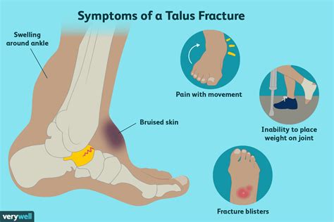 Talus Fracture Of The Ankle Symptoms Treatment And More
