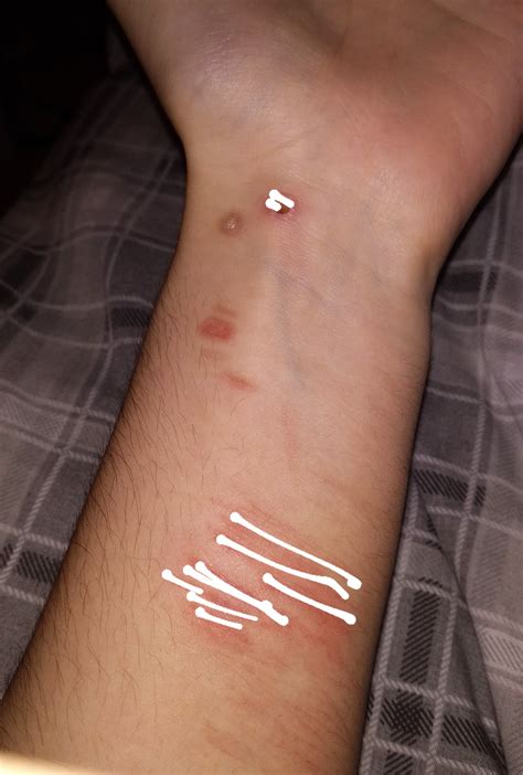 2 Days Clean Burns Are Healing Nicely But I Hate How Superficial My