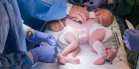 Conjoined Twins Successfully Separated