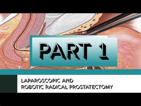 Laparoscopic And Robotic Radical Prostatectomy Surgical Procedure YouTube