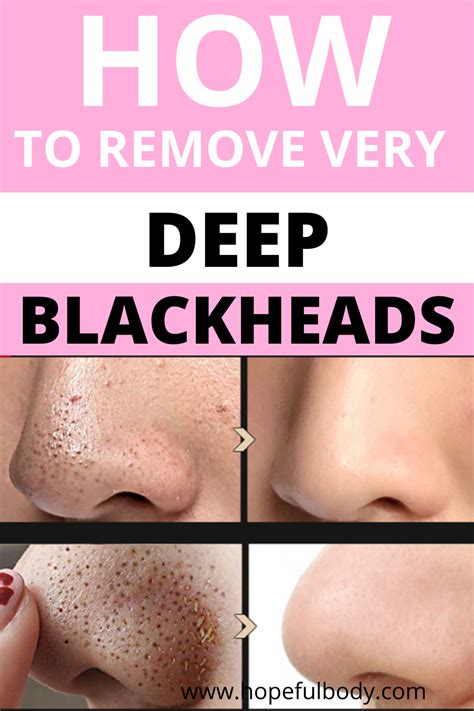 How To Get Rid Of Blackheads Easy At Home Howtoeromv
