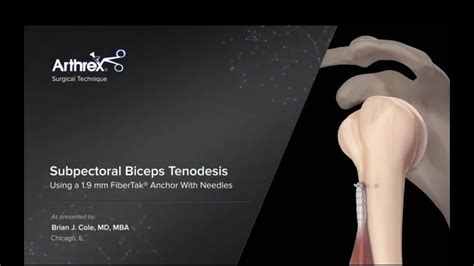 Subpectoral Biceps Tenodesis Using A 19 Mm Fibertak® Anchor With