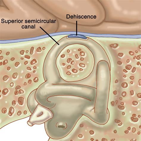 Superior Semicircular Canal Dehiscence - Otologist NYC