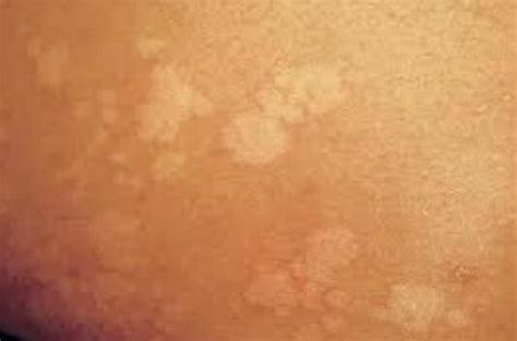 White Spots On Skin 14 Causes With Treatment