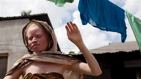 The Silent Killer Of Africas Albinos Bbc Future