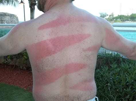 19 Truly Terrible Sunburns The Hollywood Gossip