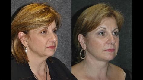 55 Year Woman 10 Days After Facelift Recovery Before And After Deepplanefacelift Youtube