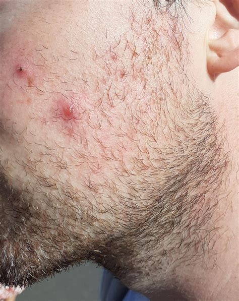 i constantly have large boils spots like this on my cheeks at least 1 appears a week could