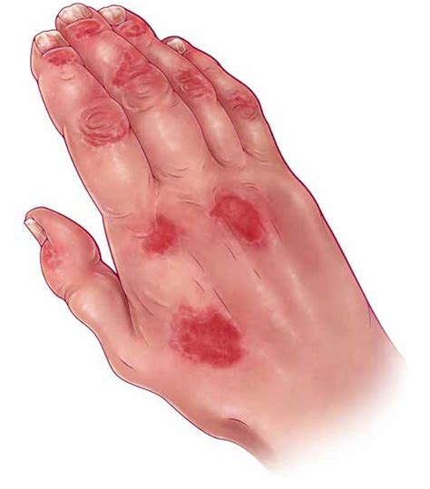 A Rash Of Evidence Evaluating And Treating Psoriatic Arthritis The