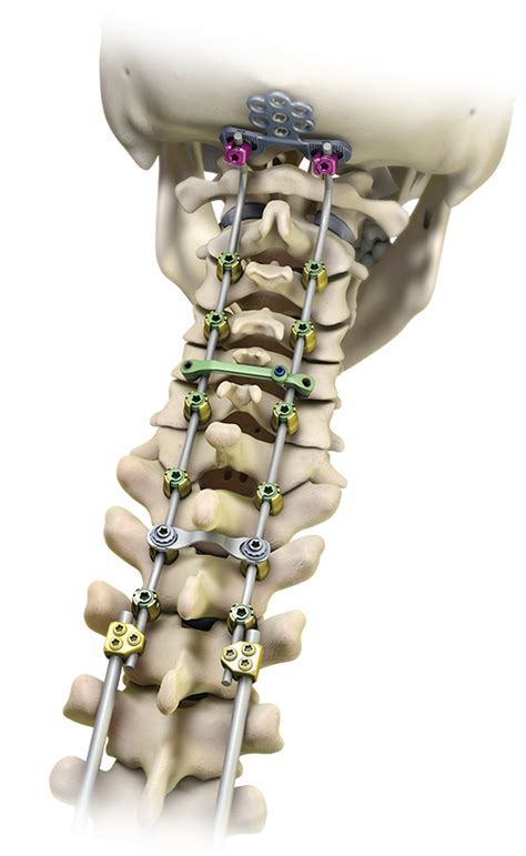 Lineum® Occipito Cervico Thoracic Oct Spine System