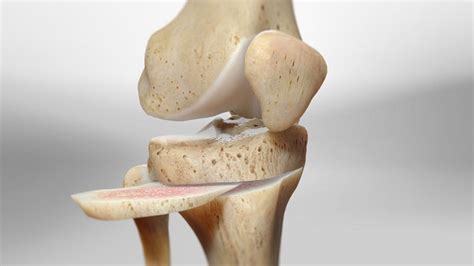 Best Knee Osteotomy Surgery In Delhi Cost Effective