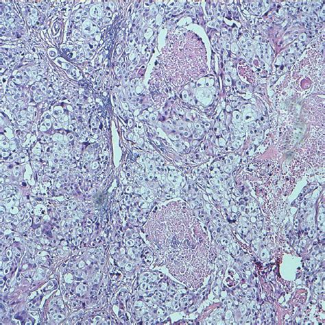 Well Differentiated Squamous Cell Carcinoma Keratinising Type With