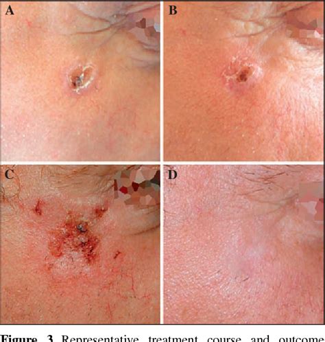 Figure From Cryosurgery Is More Effective In The Treatment Of Primary Non Superficial Basal