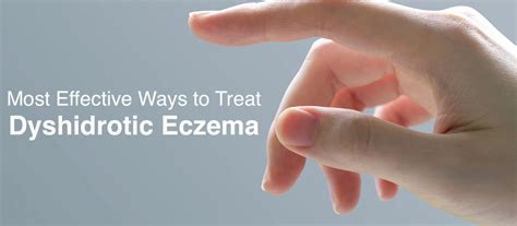 Best Treatment For Dyshidrotic Eczema
