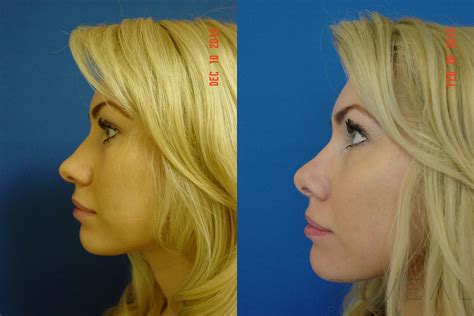 Rhinoplasty Before And After Pictures Case 101 San Jose Ca Reveal