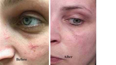 Telangiectasia Broken Capillary Before And After Skin Essence A Day Spa